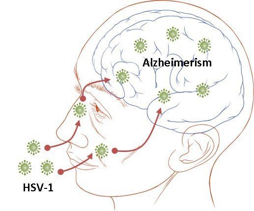 Herpes en el cerebro: ganando reconocimiento como un posible agente etiológico en la enfermedad de Alzheimer