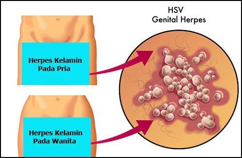 Obat herbal penyakit herpes kelamin